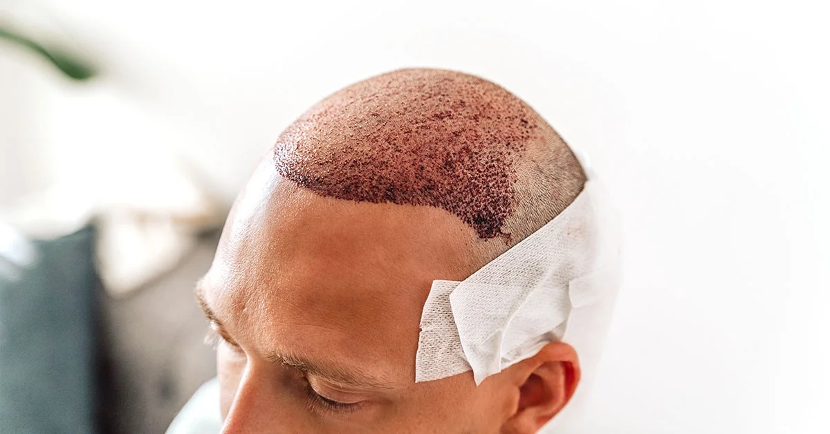 Hair Transplant Netherlands